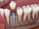 Срок службы зубного имплантата: как влияет на стоимость и выгодно ли переплачивать за долговечность